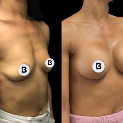 Buffalo Plastic Surgery - Breast aug before and after
