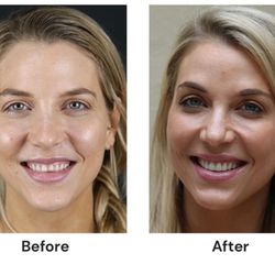 The Hills Dental Spa - Before and after porcelain veneers