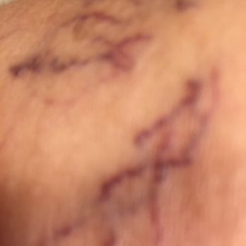Hamilton Vascular - Hamilton Vein RUINED my legs!!!BEWARE, Every injection caused clusters of Broken Veins! - Vascular Medicine Near Me - Round Rock, Texas