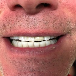 Westbury Family Dental - After UV bleaching