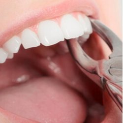 A 1 Dental - Extracción simple de diente