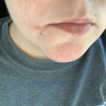 Sage Dental - The burn immediately following my appt - General Dentistry Near Me - Buford, Georgia