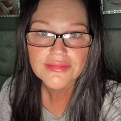 Face Forward Aesthetics - The morning after 1ml of lip filler & 50units of Botox