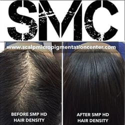 Scalp Micropigmentation Center - Scalp Micropigmentation Training Center
