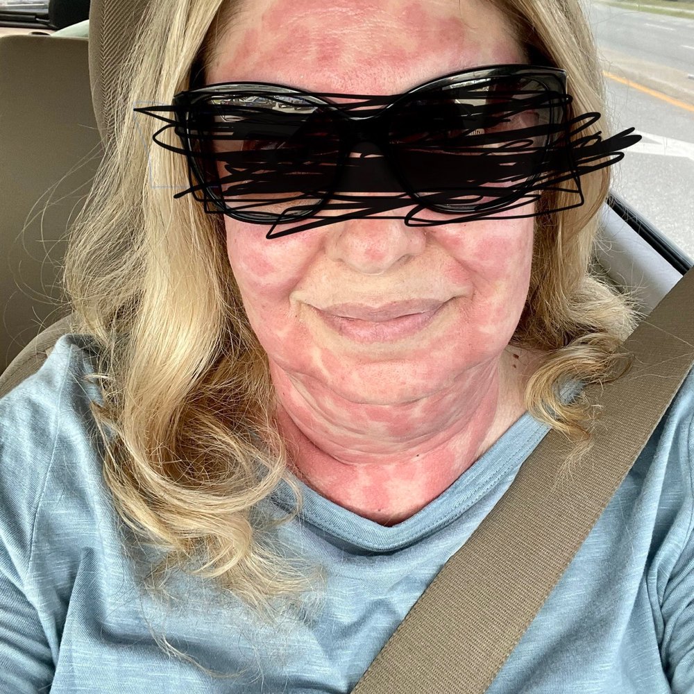 Laser Loft - My face less than 24 hours after procdure - Skin Care Near Me - Ponte Vedra Beach, Florida