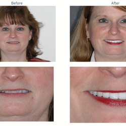Firouzian Dentistry - Full mouth reconstruction rebuilt her bite and gave her a beautiful smile.