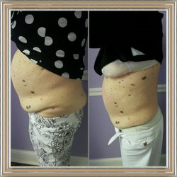 Anti Aging Center of Boca - This is the result of 4 sessions after she lost 39"
