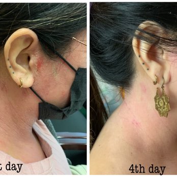 Tsai Charlis OMD - Already see the improvement from day 1 to day 4 - Acupuncture Near Me - San Gabriel, California Tsai Charlis OMD - Already see the improvement from day 1 to day 4 - Acupuncture Near Me - San Gabriel, California