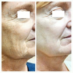 Lipogenex Anti-Aging Center: Emmanouil Karampahtsis, NMD - CO2 Laser