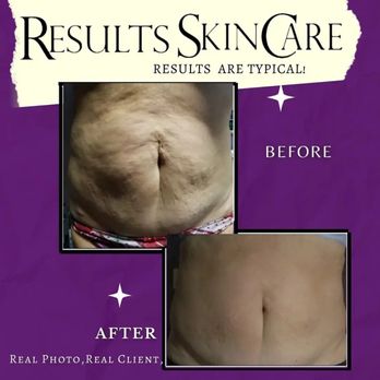 Results Skincare - FDA APPROVED Laser lipo, fat cavitation. Results are typical. Approved to tighten even the skin on the neck. - Skin Care Near Me - Red Lion, Pennsylvania Results Skincare - FDA APPROVED Laser lipo, fat cavitation. Results are typical. Approved to tighten even the skin on the neck. - Skin Care Near Me - Red Lion, Pennsylvania