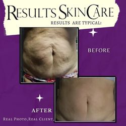 Results Skincare - FDA APPROVED  Laser lipo, fat cavitation. Results are typical. Approved to tighten even the skin on the neck.