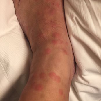 Residence Inn by Marriott Arlington - Flea bites from one night at the hotel - Hotels Near Me - Arlington, Texas Residence Inn by Marriott Arlington - Flea bites from one night at the hotel - Hotels Near Me - Arlington, Texas