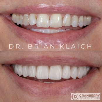 Cranberry Dental Studio - This patient had a full mouth smile makeover completed to address the wear and color of her teeth. What a difference! - General Dentistry Near Me - Cranberry Twp, Pennsylvania Cranberry Dental Studio - This patient had a full mouth smile makeover completed to address the wear and color of her teeth. What a difference! - General Dentistry Near Me - Cranberry Twp, Pennsylvania