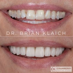 Cranberry Dental Studio - This patient had a full mouth smile makeover completed to address the wear and color of her teeth. What a difference!