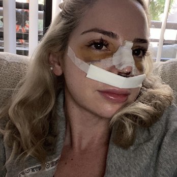 Vladimir Grigoryants, MD - 6 days post surgery - Cosmetic Surgeons Near Me - Glendale, California Vladimir Grigoryants, MD - 6 days post surgery - Cosmetic Surgeons Near Me - Glendale, California