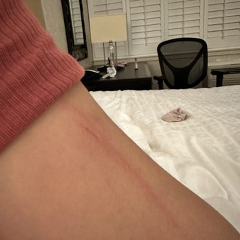 Best Western Corte Madera Inn - This bedbugs bite me in arms legs everywhere in my body! - Hotels Near Me - Corte Madera, California