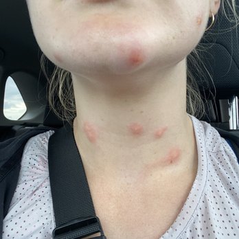 Best Western Macomb Inn - Bed bug bites!! Over 20 of them! - Hotels Near Me - Macomb, Illinois Best Western Macomb Inn - Bed bug bites!! Over 20 of them! - Hotels Near Me - Macomb, Illinois
