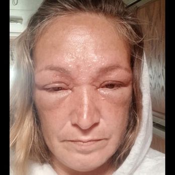 Sparkle Nails & Spa - Today, eyes almost sealed shut August 10th 2019 - Nail Salons Near Me - Marysville, Washington
