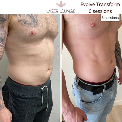 InMode Evolve X - EvolveX is a safe and effective procedure for muscle sculpting and toning. Option to use transform (fat burning + toning), Tone (EMS technology), & Tite ( RF technology). Call to schedule a consultation to see which treatment would be best suitable for your body. InMode Evolve X - EvolveX is a safe and effective procedure for muscle sculpting and toning. Option to use transform (fat burning + toning), Tone (EMS technology), & Tite ( RF technology). Call to schedule a consultation to see which treatment would be best suitable for your body.