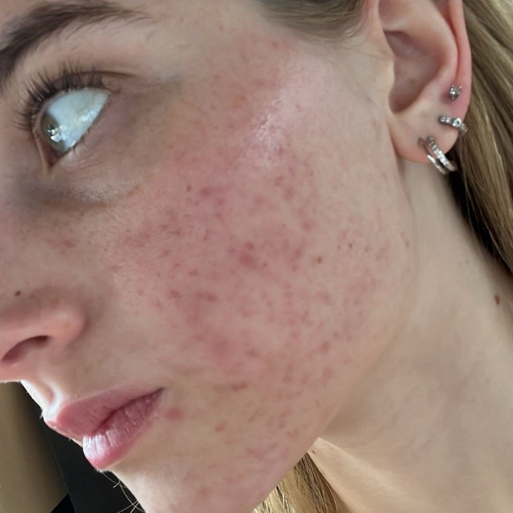 SALT Esthetics + Wellness - My skin after my 2nd chemical peel - Estheticians Near Me - Riverside, California