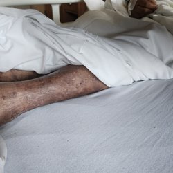 Hamilton Continuing Care Center - months of wound neglect, emergency amputation required