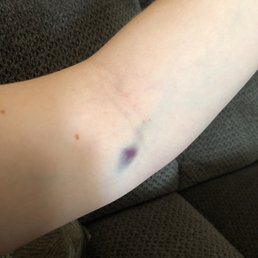 They blew another vein in my arm! This is the second time. I know something was wrong when it hurt after. I couldn't even drive w/ this arm