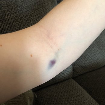 Quest Diagnostics - They blew another vein in my arm! This is the second time. I know something was wrong when it hurt after. I couldn't even drive w/ this arm - Laboratory Testing Near Me - Hesperia, California
