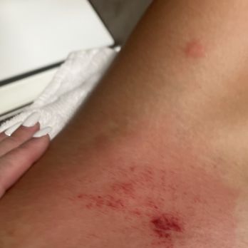 Maui Vista Condominium - Bedbugs bites - Condominiums Near Me - Kihei, Hawaii Maui Vista Condominium - Bedbugs bites - Condominiums Near Me - Kihei, Hawaii