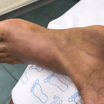 Gary Saphire, DPM, FACFAS - My Lisfranc Injury - Podiatrists Near Me - Brooklyn, New York