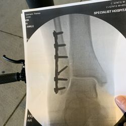 Orthopaedic Specialists of Louisiana - 4 wk check up on