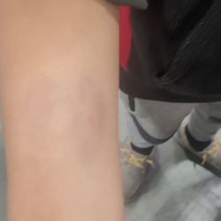 Rowell Elementary - Bullying marks kid bit my kid