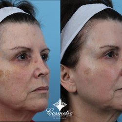Cosmetic Dermatology Center - Improved skin quality and laxity after one treatment of the Pixel Co2