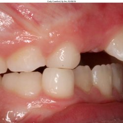 Paulson Orthodontics - Overbite before starting treatment