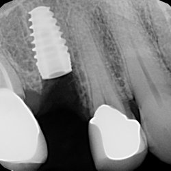 The Wright Dentist - Implant restoration