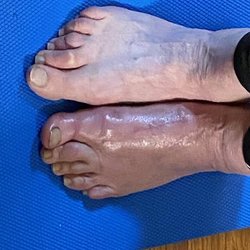 Steven H. Silvers DPM - Photo 6 month post surgery -- still swollen, painful and purple