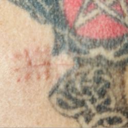 Alaska Center For Dermatology - Day 16 recovery