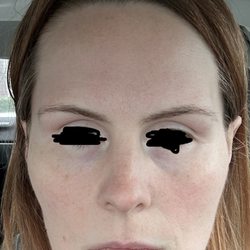 Rejuve Anti Aging - Before first treatment- front face