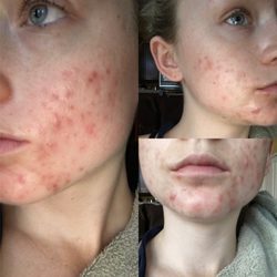 Joia Skin - Before Acne bootcamp