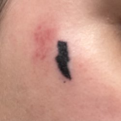 Tattoo 42 - After the tattoo was finished and filled in + the skin damage