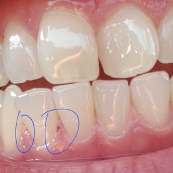 Gold Coast Dental Brea - Look at the tip of my gums!!! It's almost off! My entire mouth hurts like I was punched in the mouth! - Orthodontists Near Me - Brea, California Gold Coast Dental Brea - Look at the tip of my gums!!! It's almost off! My entire mouth hurts like I was punched in the mouth! - Orthodontists Near Me - Brea, California