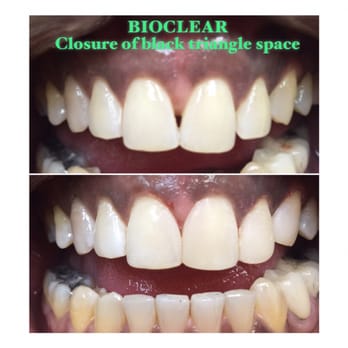 Sepulveda Smile - Bioclear bonding- closure of black triangle space after ortho treatment - Pediatric Dentists Near Me - Van Nuys, California Sepulveda Smile - Bioclear bonding- closure of black triangle space after ortho treatment - Pediatric Dentists Near Me - Van Nuys, California