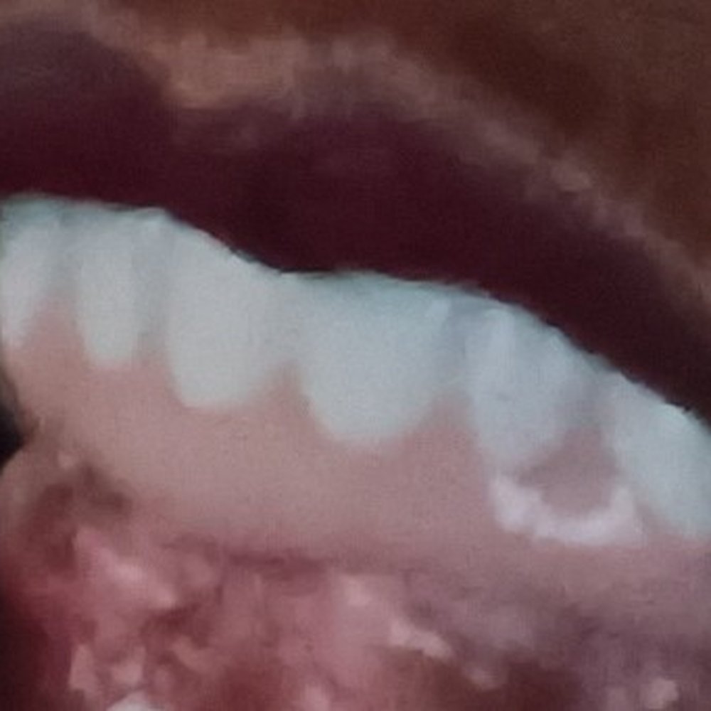 Flossy Dental Group - The bottom bridge is a nighmare its crooked sits too high, and the bite is not mine. Also the teeth are very crooked. - General Dentistry Near Me - Harbor City, California Flossy Dental Group - The bottom bridge is a nighmare its crooked sits too high, and the bite is not mine. Also the teeth are very crooked. - General Dentistry Near Me - Harbor City, California