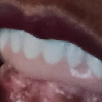 Flossy Dental Group - The bottom bridge is a nighmare its crooked sits too high, and the bite is not mine. Also the teeth are very crooked. - General Dentistry Near Me - Harbor City, California Flossy Dental Group - The bottom bridge is a nighmare its crooked sits too high, and the bite is not mine. Also the teeth are very crooked. - General Dentistry Near Me - Harbor City, California