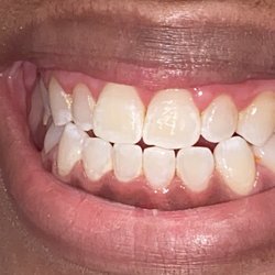 Ciera White Smile Bar - This is the after photo of my teeth