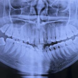 Safety Harbor Middle School - Skeletal asymmetry caused by gym accident from the staffs lack of awareness