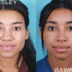 Jeffrey Rawnsley, MD - Rawnsley Plastic Surgery - Primary Rhinoplasty Before & After | Rawnsley Plastic Surgery