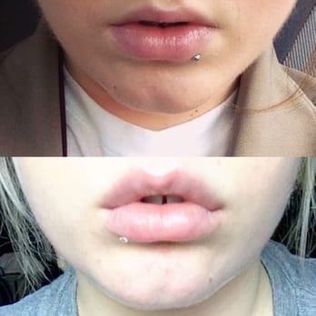 Prischmann Facial Plastic Surgery - Before and after injections - Plastic Surgeons Near Me - Golden Valley, Minnesota Prischmann Facial Plastic Surgery - Before and after injections - Plastic Surgeons Near Me - Golden Valley, Minnesota