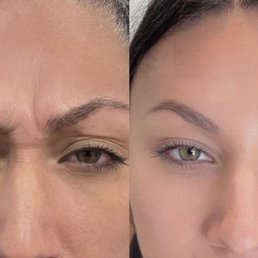 Before Botox & 2 weeks after