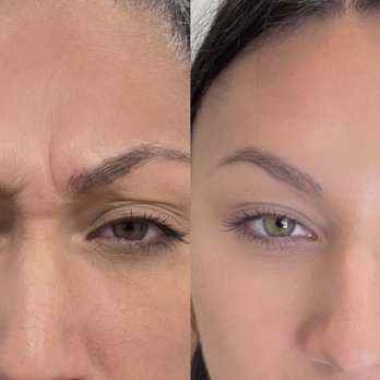 Pretty Please Aesthetics - Before Botox & 2 weeks after - Medical Spas Near Me - Sacramento, California