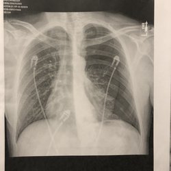 The Outer Banks Hospital Urgent Care Center - X-ray done in Phoenix showing a left side Pneumothorax